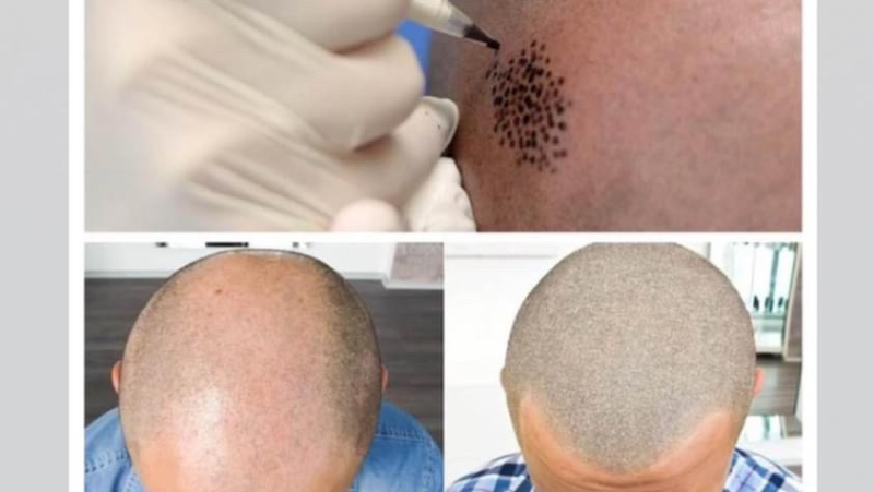Tricopigmentazione Barletta -Tricologic- — estetista a Barletta