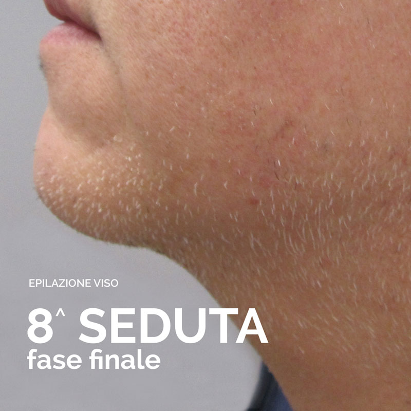 Epilazione Laser Bergamo — estetista a Bergamo
